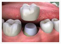 Diagram of crown
				being fitted by dentist