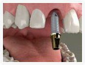 Dental
				implant step 1