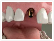 Dental implant step
				2